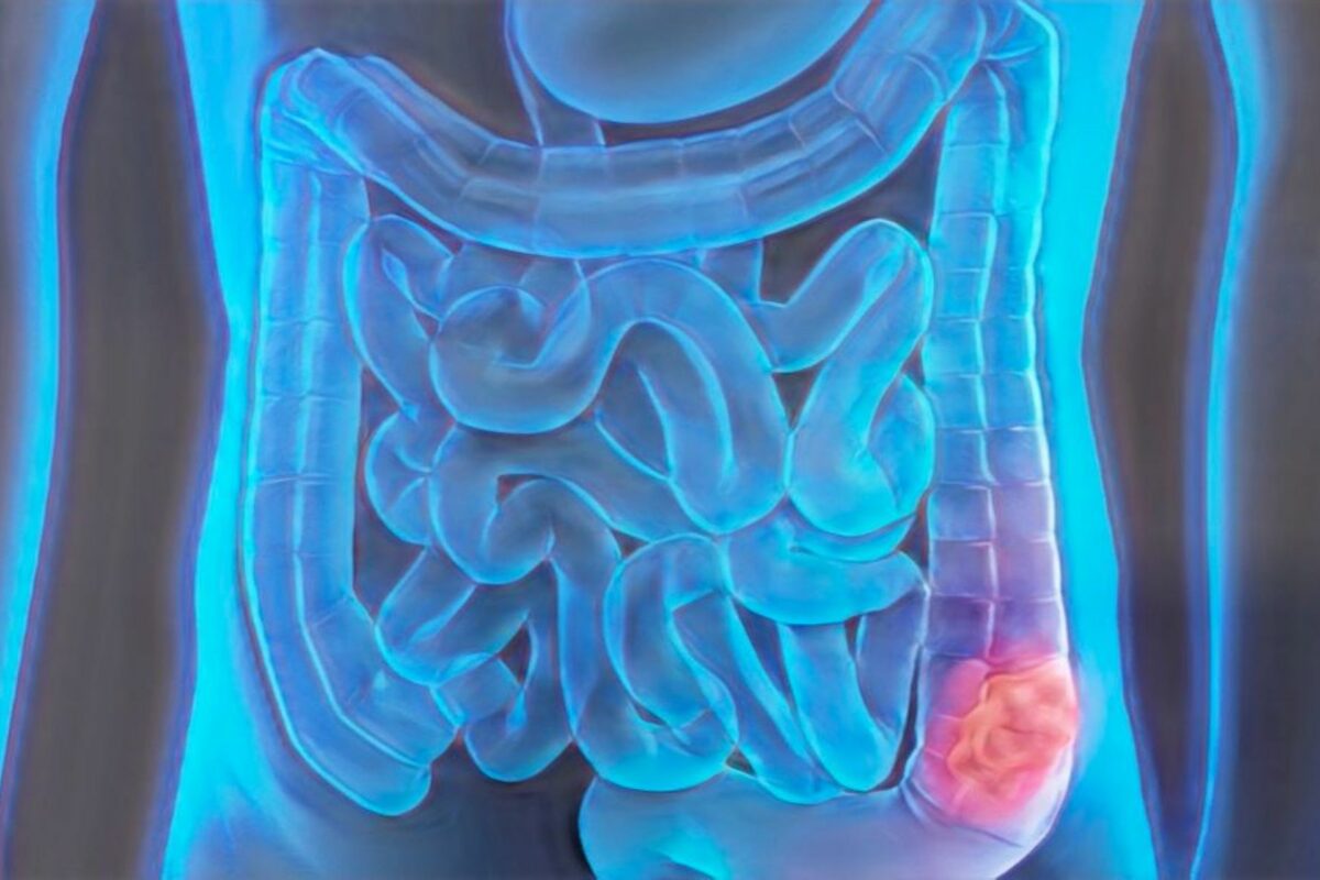 Cáncer Colorrectal en Jóvenes: El 10% de los casos ya ocurre en menores de 50 años