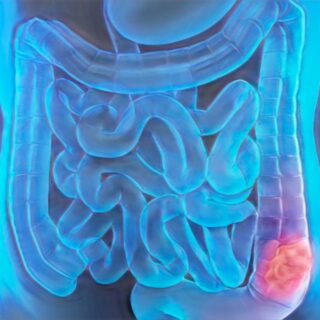 Cáncer Colorrectal en Jóvenes: El 10% de los casos ya ocurre en menores de 50 años