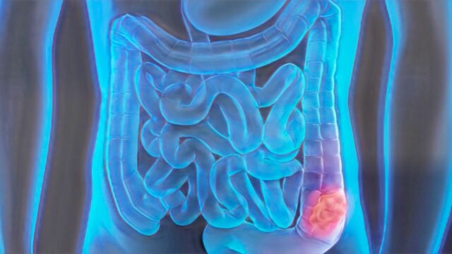 Cáncer Colorrectal en Jóvenes: El 10% de los casos ya ocurre en menores de 50 años